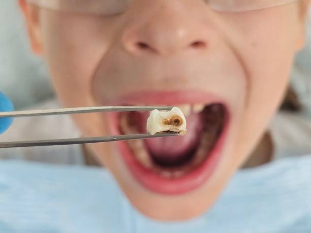 Best Emergency Dental Care for Broken or Chipped Teeth in Saw Creek, PA